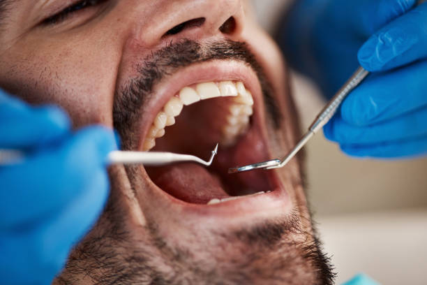 Best Chipped Tooth Repair Near Me  in Deatsville, AL