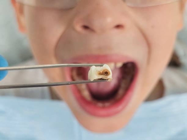 Best Chipped Tooth Repair Near Me  in Deatsville, AL